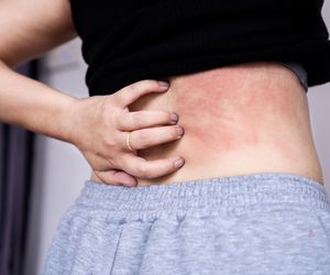 Dermatofitoza może zająć skórę, włosy i paznokcie. Sprawdź, jak ją rozpoznać