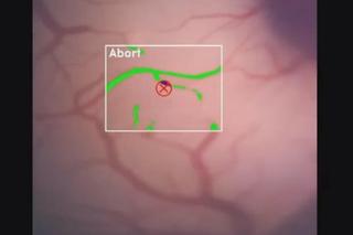 Firma Elona Muska wszczepiła pierwszemu człowiekowi chip do mózgu. Wraca do zdrowia