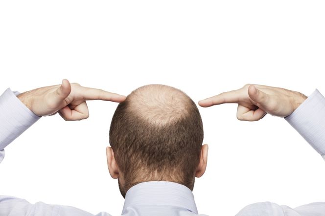 Pięć sposobów na ŁYSIENIE u mężczyzn