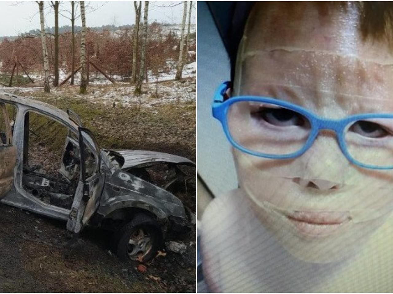 Auto spłonęło, 10-latek ciężko poparzony. Jego ciało pokryły przerażające blizny! [DRASTYCZNE ZDJĘCIA]