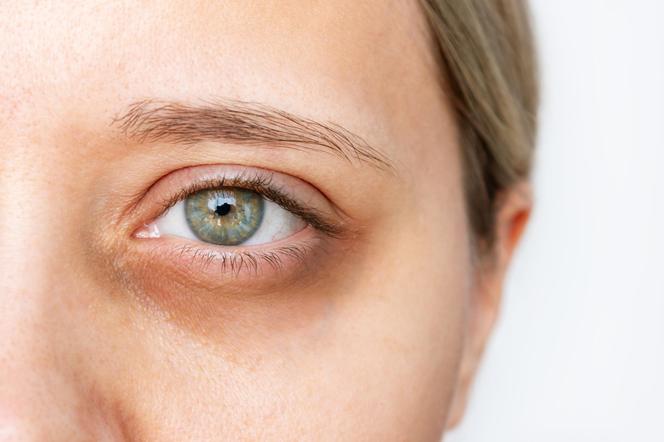 Our grandmothers' quick way to get rid of dark circles under the eyes.  Is it safe?