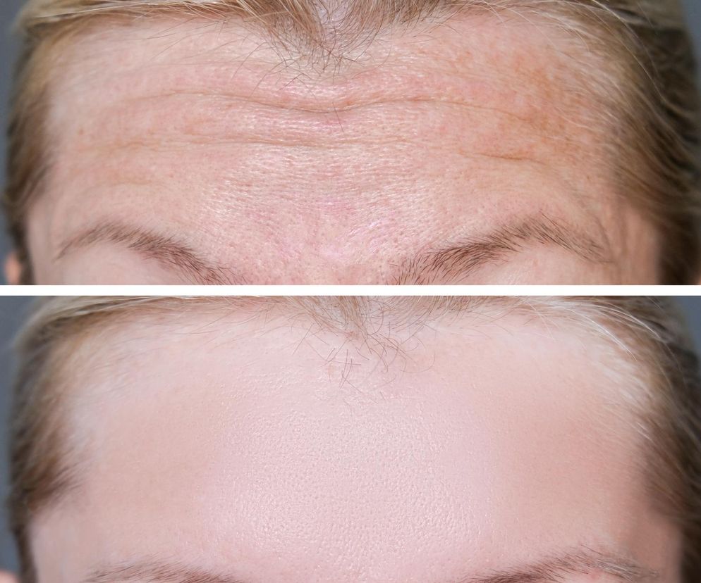 Planujesz botoks? 7 faktów, o których powinnaś wiedzieć, zanim zdecydujesz się na zabieg