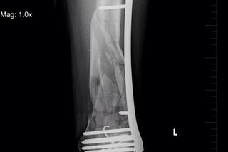 Wyrwą mi śruby z nogi