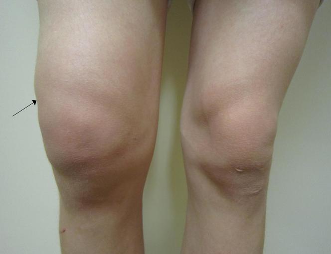 Woda w kolanie- jak rozpoznać objawy wysięku w stawie kolanowym?