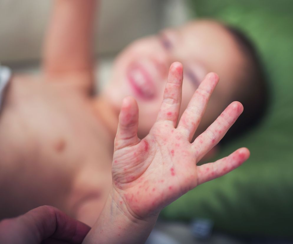 Różyczka jest ostrą chorobą wirusową o niegroźnym przebiegu.