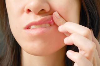 Afty w jamie ustnej – skąd się biorą i jak szybko się ich pozbyć?