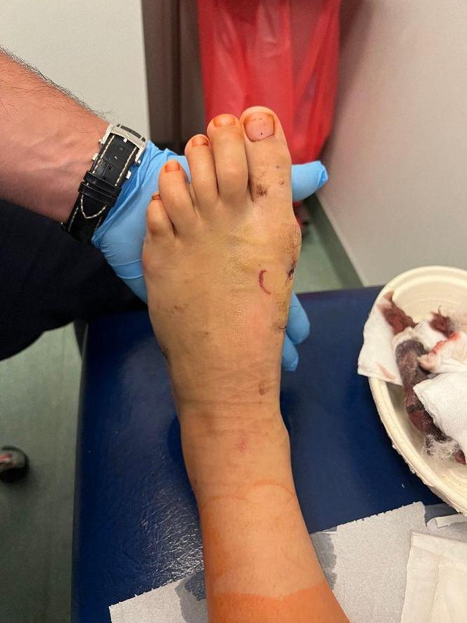 Chorzów. Innowacyjny zabieg u dziecka przeprowadzony po raz pierwszy na Śląsku