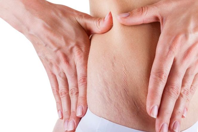 ROZSTĘPY - jak pozbyć się rozstępów z ud, pośladków, brzucha i piersi?