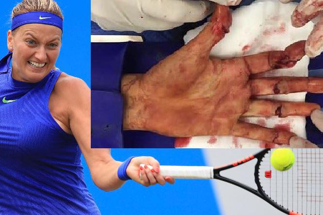 Petra Kvitova, zraniona dłoń