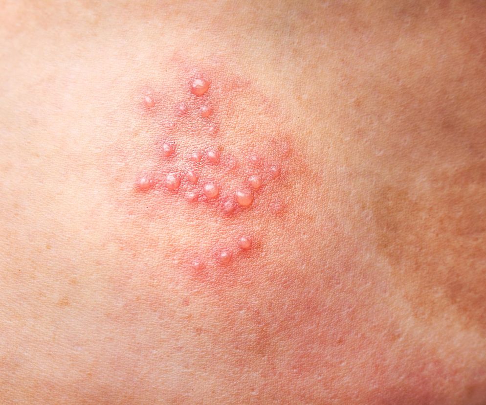 Półpasiec może zwiększać ryzyko udaru. Odpowiada za to lekceważony wirus