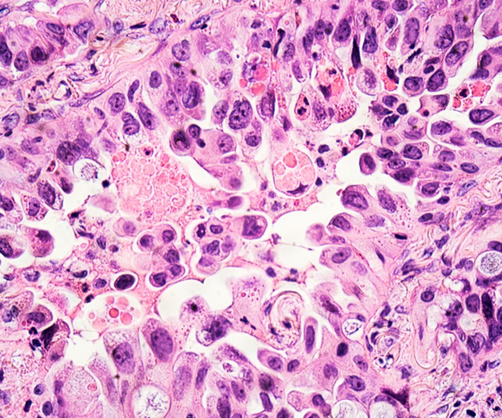 Gruczolakorak (rak gruczołowy) - gdzie występuje? Objawy i leczenie
