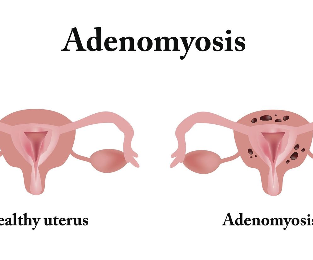 Adenomioza to odrębna nazwa dla ognisk endometriozy, umiejscowionych wewnątrz błony mięśniowej macicy, czyli myometrium