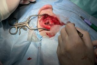 W Szpitalu Ludwika Rydygiera w Krakowie wszczepili implanty ślimakowe