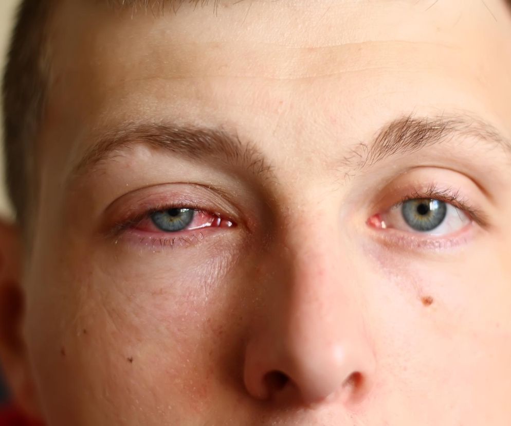 13 tys. przypadków jednego dnia. Narasta epidemia różowego oka