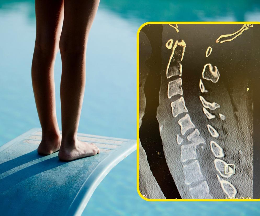 23 lata, ofiara imprezy. Lekarz pokazał zdjęcie złamanego kręgosłupa i zaapelował do innych