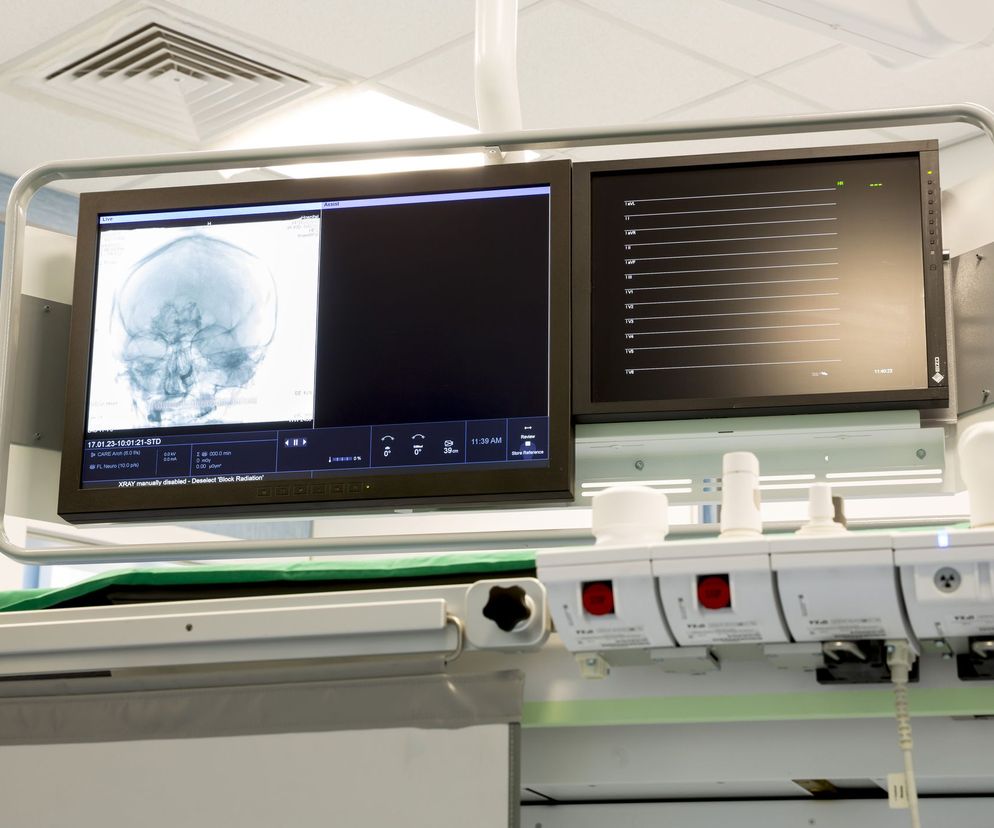 Wyściółczak to nowotwór, który powstaje w ośrodkowym układzie nerwowym.