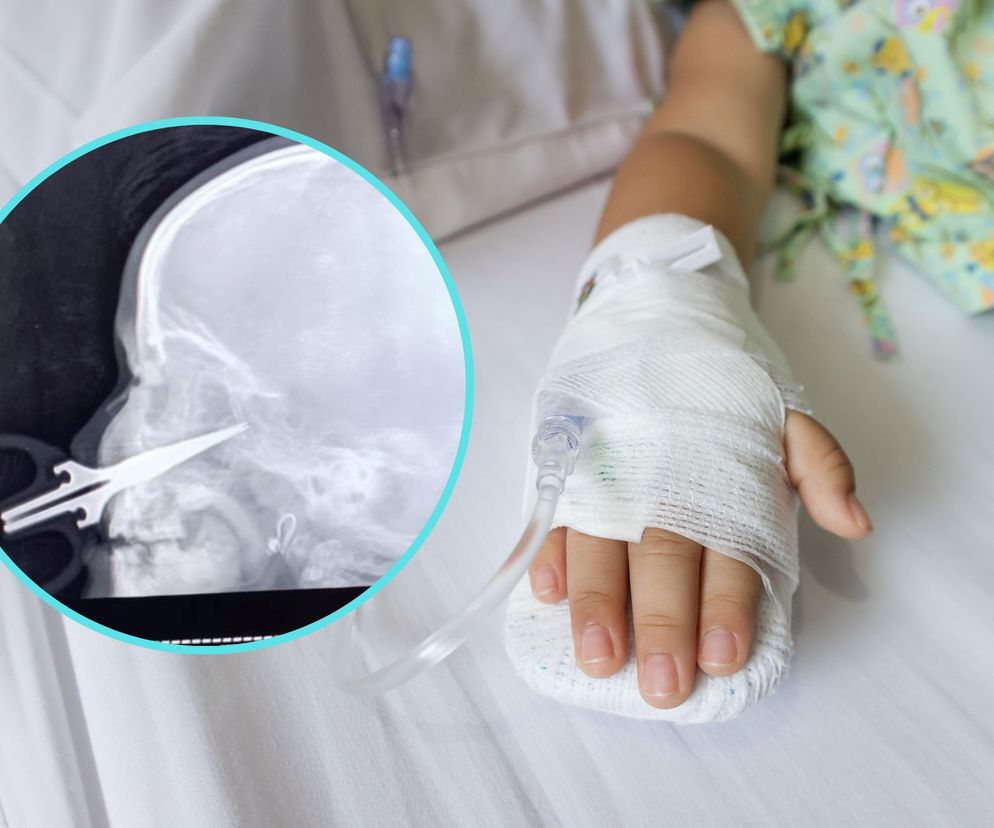 5-latka nadziała się na nożyczki podczas zabawy. Lekarz dokonali cudu