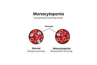 Monocytopenia: przyczyny, objawy