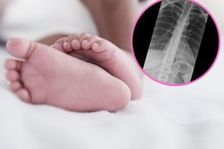 5-miesięczna dziewczynka nagle zaczęła tracić przytomność. RTG pokazało przyczynę 