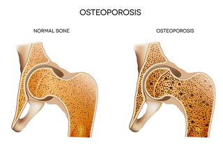 Warszawski Senior: Mądre kości po szkodzie! Osteoporoza ATAKUJE!