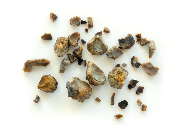 Kamienie nerkowe – metody leczenia