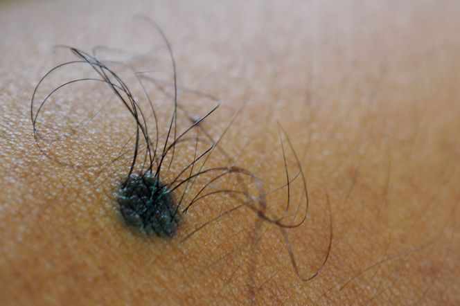 Znamię Beckera: definicja, obraz kliniczny, rozpoznanie, różnicowanie, leczenie