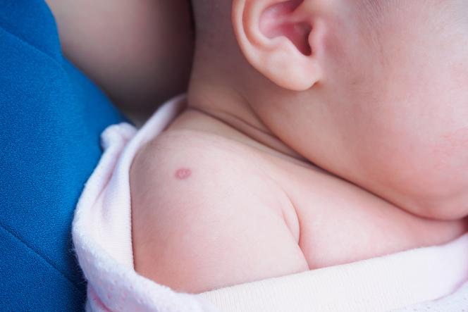 Ślad po szczepionce przeciw gruźlicy: jak powinien wyglądać?