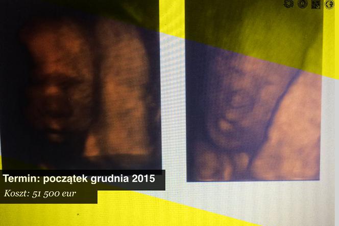 Pomóżmy Zosi! Cierpi na rzadki zespół Ebsteina, 240 tys. zł uratuje jej życie!