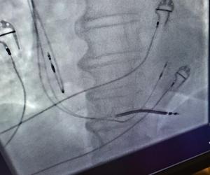 Kolejny sukces lekarzy z Gliwic. Wszczepili pacjentowi nowoczesny rozrusznik serca