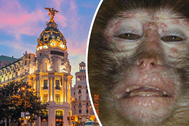 Hiszpania/ Alert sanitarny w Madrycie z powodu wirusa małpiej ospy
