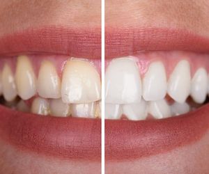 Wybielenie zębów - jak wybielić zęby?