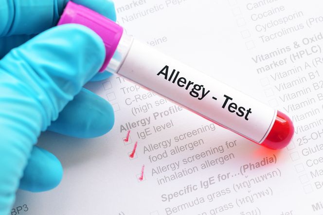 Test RAST (test radioalergoseparacji): kiedy go wykonać? Jak przebiega?