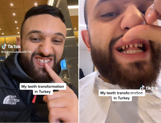 Tureckie zęby kosztowały go 13 tys. zł. Dentyści, którzy zobaczyli efekt, byli przerażeni