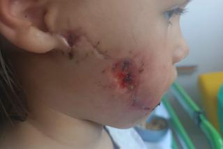 Amstaff rozszarpał buzię 4-letniej Nadii