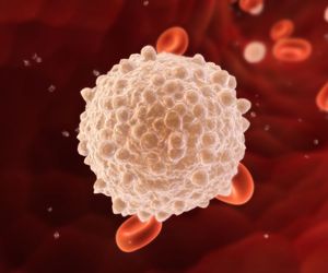 Makroglobulinemia Waldenströma: przyczyny, objawy, leczenie i rokowania