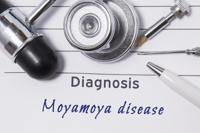 Choroba moyamoya: przyczyny, objawy, leczenie