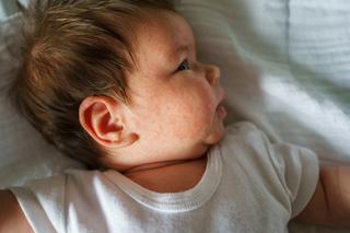 Alergia pokarmowa, wziewna i skórna. Po czym poznać, że niemowlę jest uczulone?