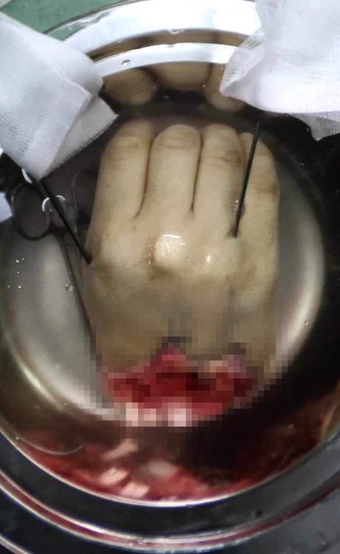 Przyszyła dłonie odcięte gilotyną