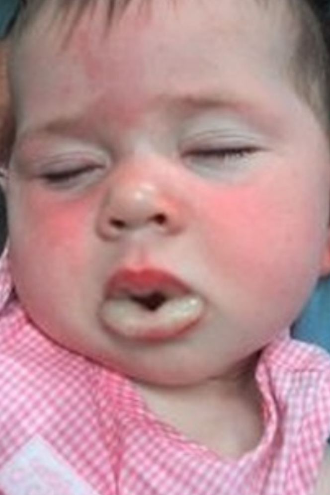 Reakcje alergiczne u dzieci
