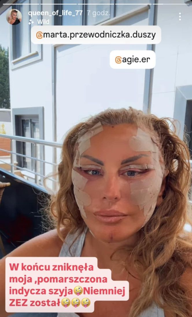 Dagmara Kaźmierska po operacji twarzy
