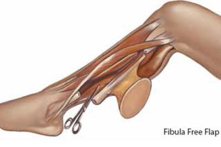 Z kości strzałkowej odtworzono żuchwę. Szpital w Zielonej górze mówi o unikalnej operacji [ZDJĘCIA]