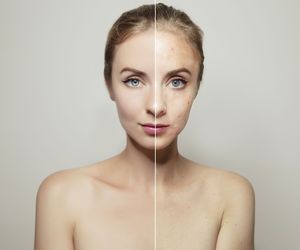 Gruczoły łojowe: budowa i funkcje. Choroby gruczołów łojowych