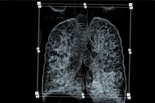 Zabrze: Drugą taką operację na świecie wykonano na Śląsku!