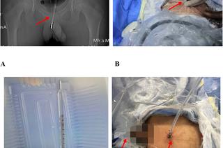 12-latek włożył sobie termometr do penisa. Szokująca zabawa erotyczna nastolatka