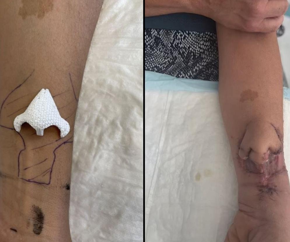 Zniszczony po radioterapii nos pacjentki lekarze zastąpili nowym. Przez pewien czas implant rósł na przedramieniu. Po lewej stronie widać rusztowanie z biomateriału, po prawej - efekt końcowy przez zabiegiem przeszczepienia. 