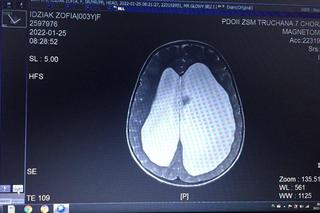 6-letnia Zosia z Tychów potrzebuje pomocy internautów, żeby stanąć na nogi 