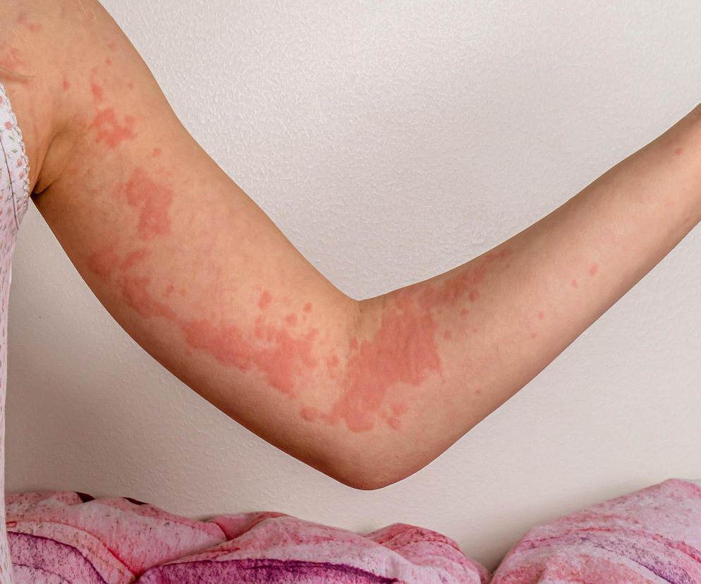  Jest jak tykająca bomba. Jej objawy można łatwo pomylić z alergią pokarmową | #MEDetektyw