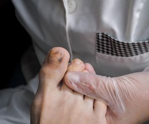 To siniak czy objaw nowotworu? Masz taką zmianę, idź do lekarza