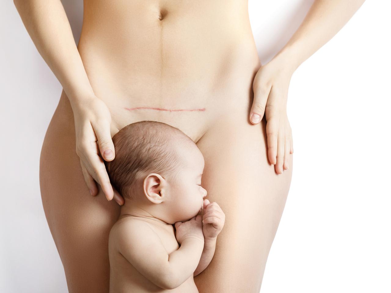 Blizna po cesarce nie musi być widoczna. Jakie są najlepsze maści na blizny?