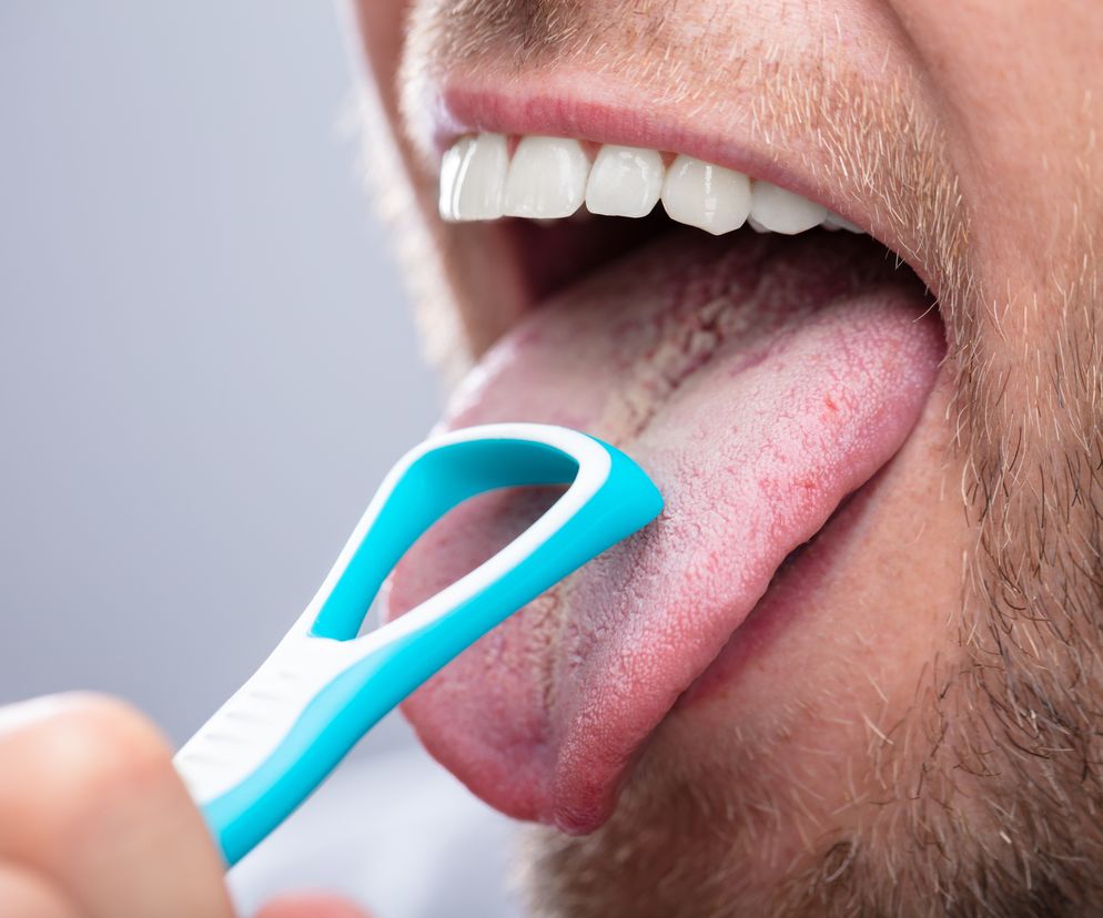 Nalot na języku - przyczyny. Co oznacza obłożony język?